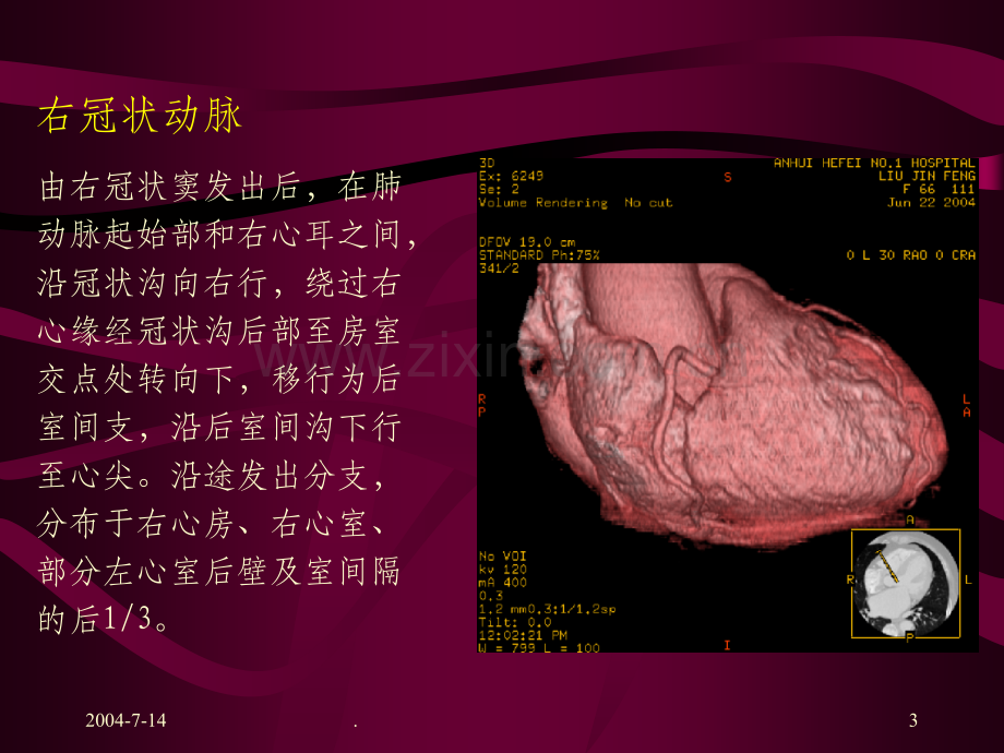 冠状动脉的解剖及CT表现.ppt_第3页