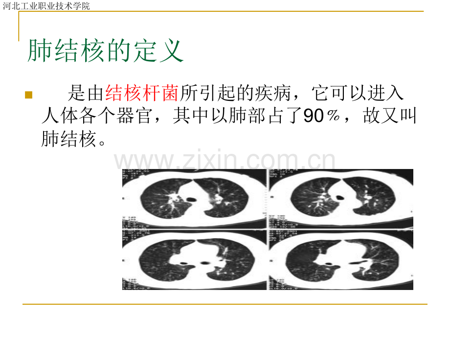 肺结核ppt本.ppt_第3页