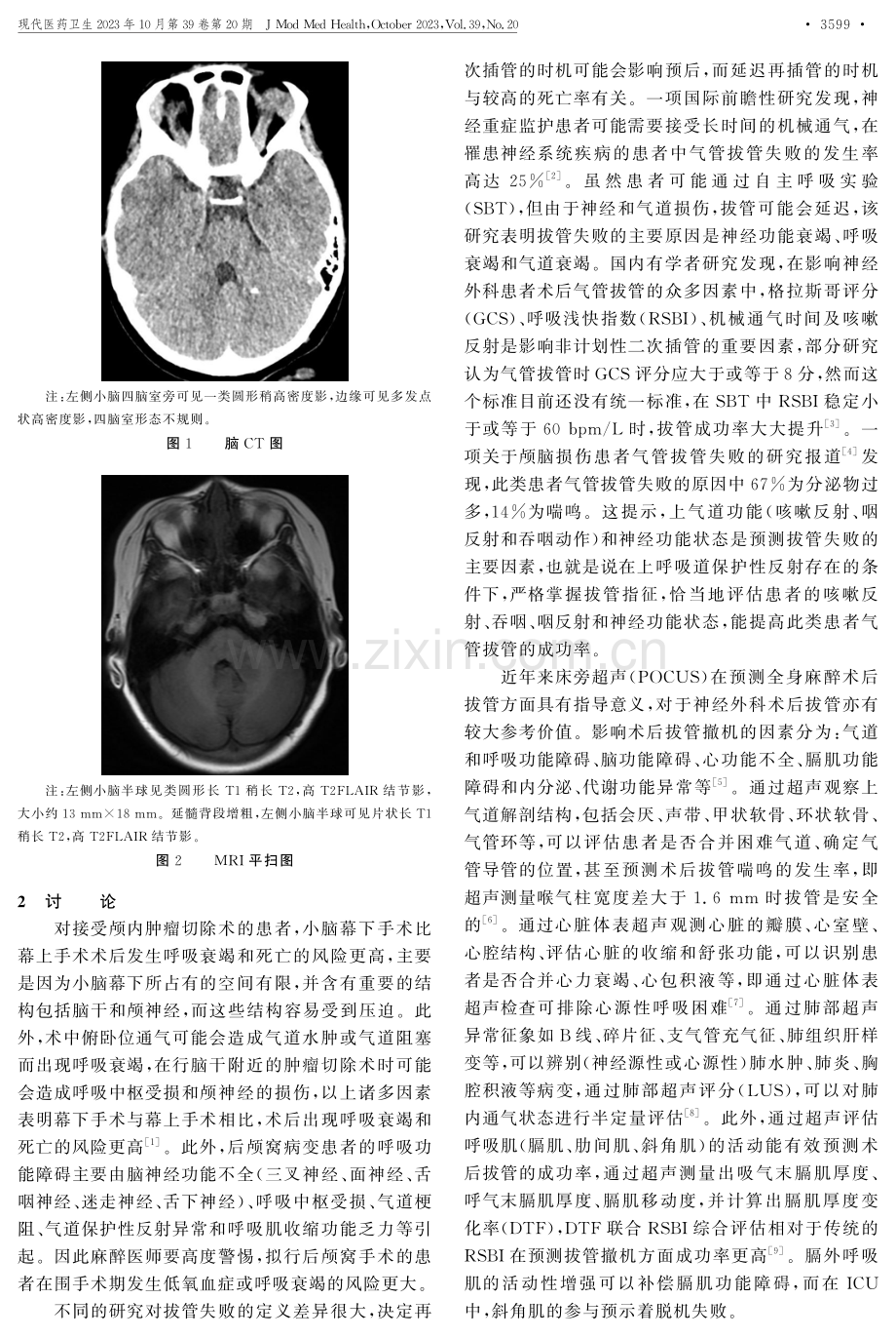 后颅窝肿瘤患儿在全身麻醉术后再次行气管插管1例.pdf_第3页