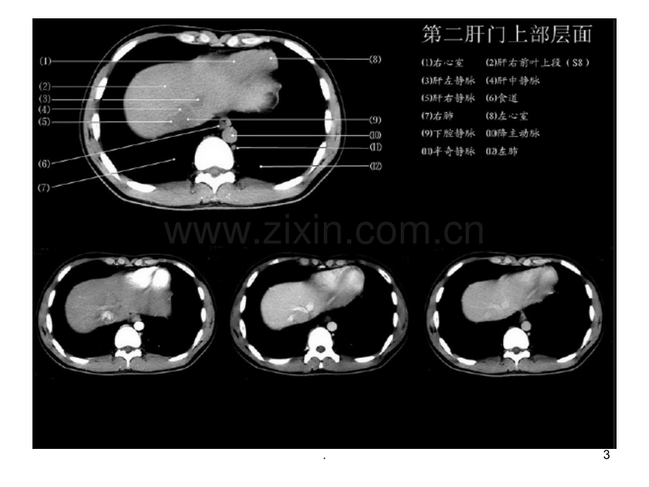 正常肝脏CT解剖图.ppt_第3页