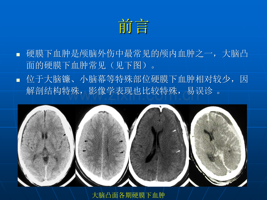 小脑幕硬膜下血肿.ppt_第3页