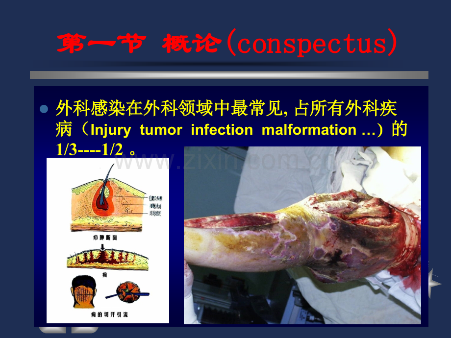 全身性外科感染ppt医学.ppt_第2页