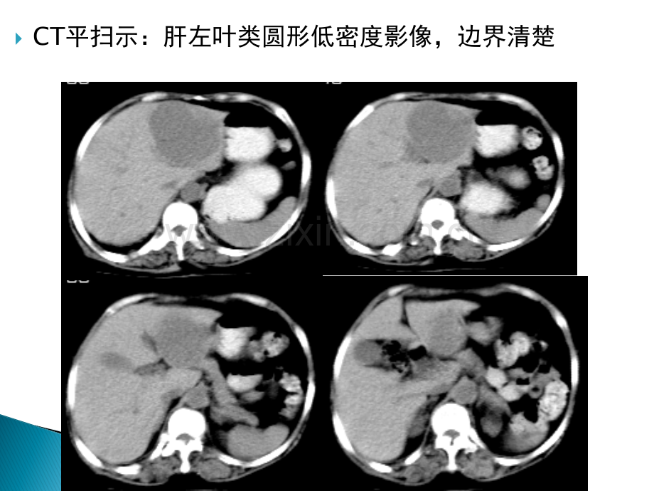 肝海绵状血管瘤.ppt_第3页