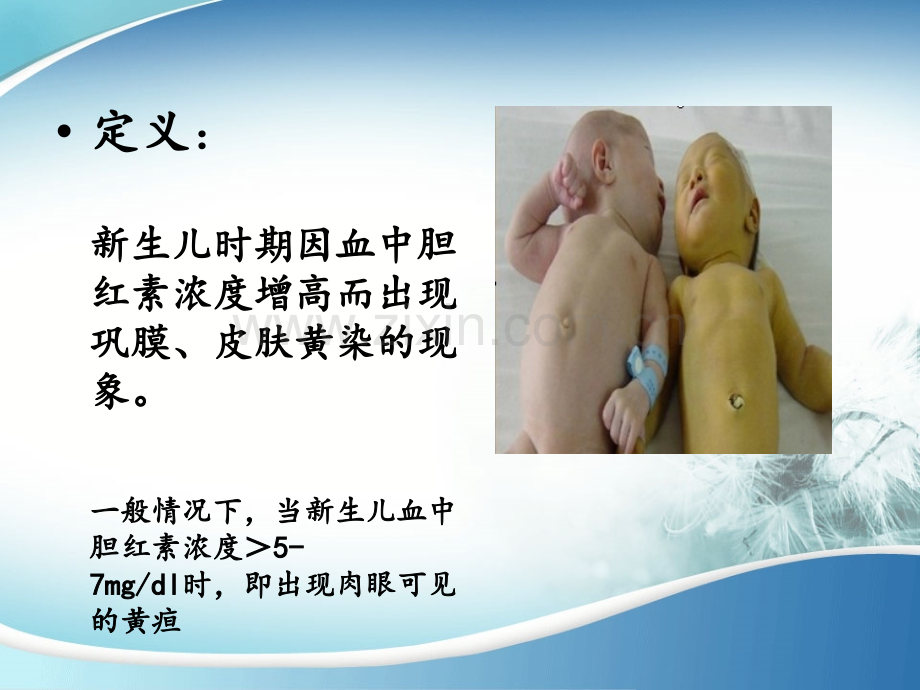 新生儿高胆红色血症.ppt_第3页