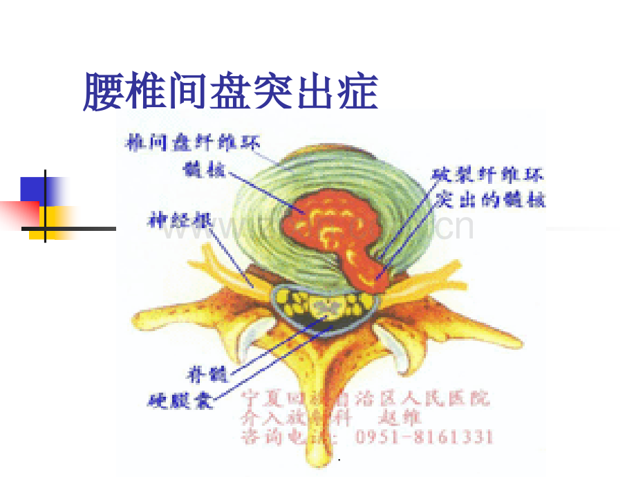 腰椎间盘突出.ppt_第1页