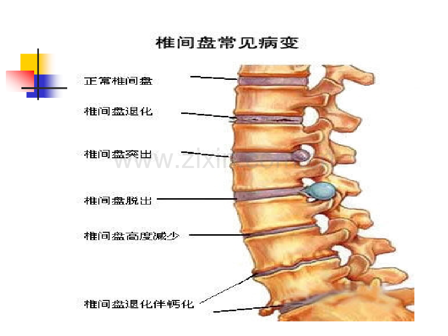 腰椎间盘突出.ppt_第2页