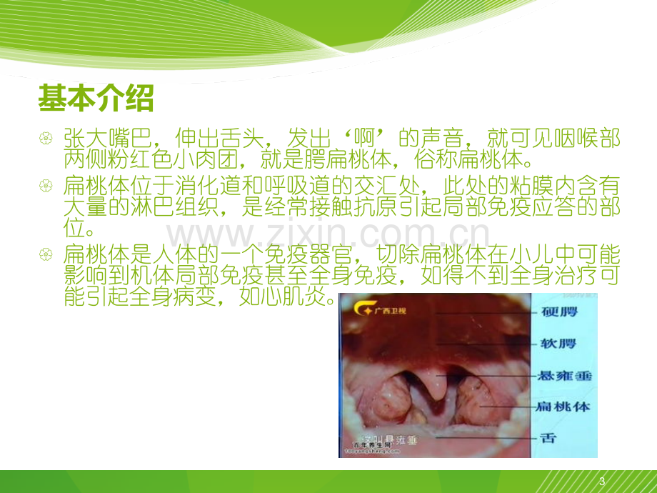 扁桃体术后的护理.ppt_第3页