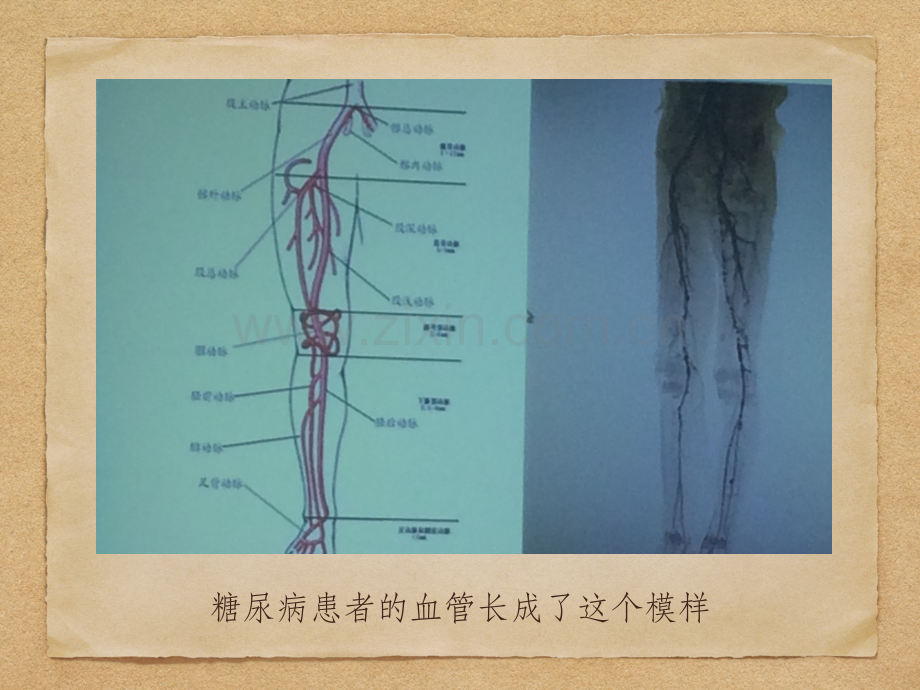 糖尿病患者的麻醉管理.pptx_第3页