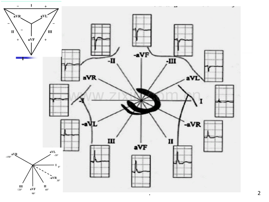 心电图aVR导联新价值.ppt_第2页
