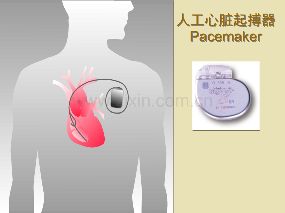 永久性心脏起搏器临床应用.ppt_第2页