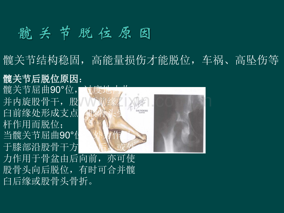 髋关节脱位PPT医学.ppt_第3页