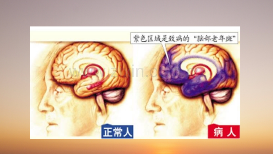 老年痴呆患者的健康教育医学PPT课件.pptx_第3页