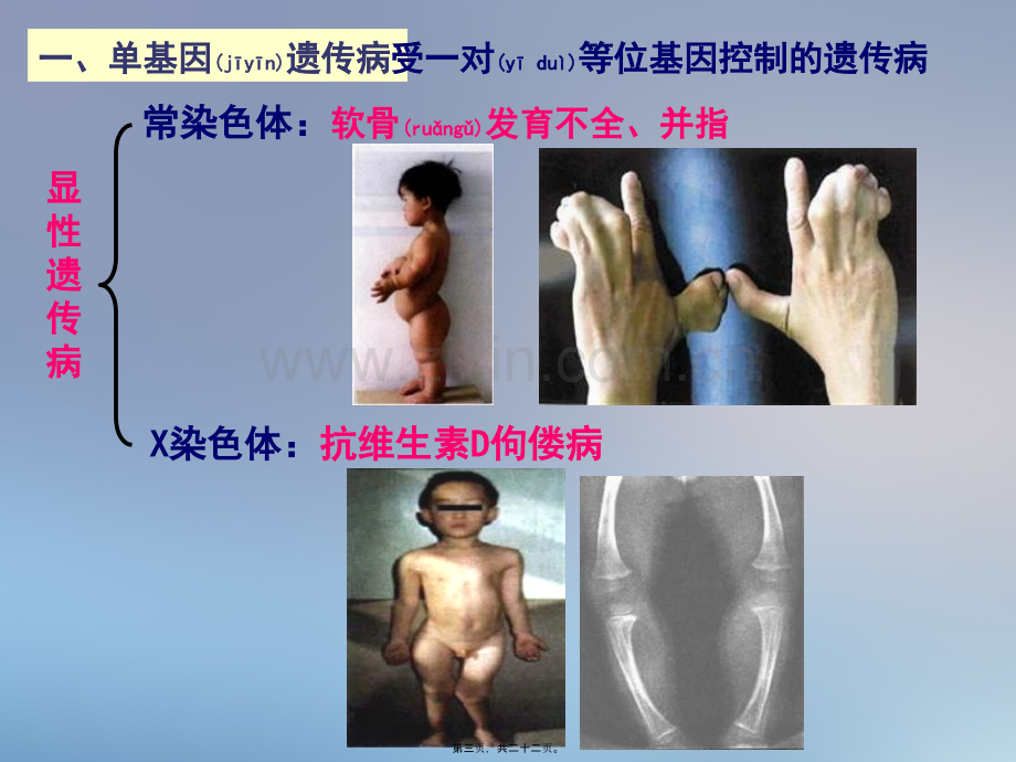 53--人类遗传病与优生.ppt_第3页