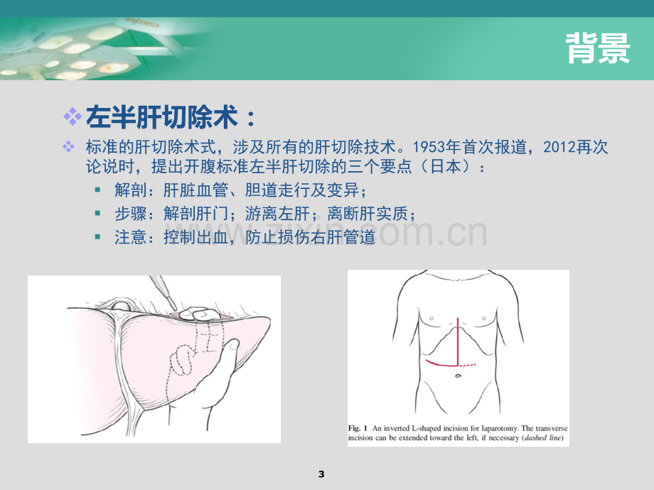 腹腔镜下解剖性左半肝切除术讲诉.ppt_第3页