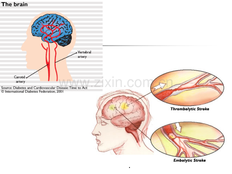 脑血管疾病.ppt_第3页