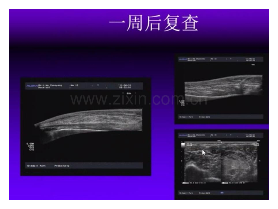 肌肉骨骼系统超声.ppt_第3页