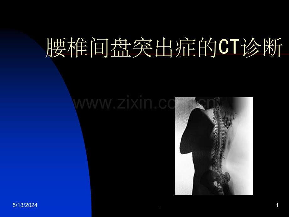 椎间盘突出症的CT表现.ppt_第1页