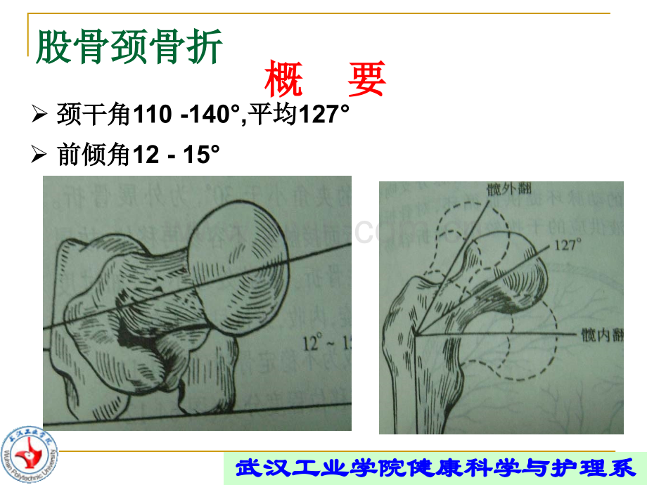 股骨颈骨折的康复.ppt_第2页