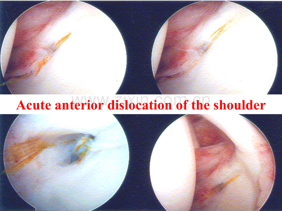 肩关节前脱位Anterior-Shoulder-Dislocation.ppt_第1页