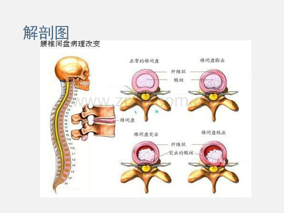 腰椎间盘突出症的护理.pptx_第3页