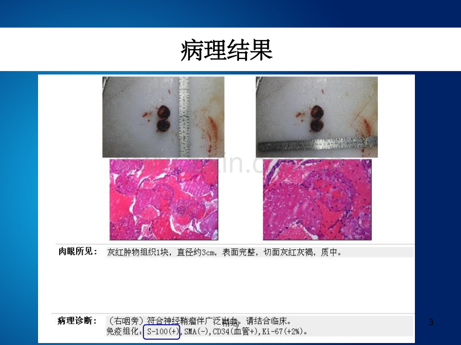 胃神经鞘瘤的诊断与鉴别诊断.ppt_第3页