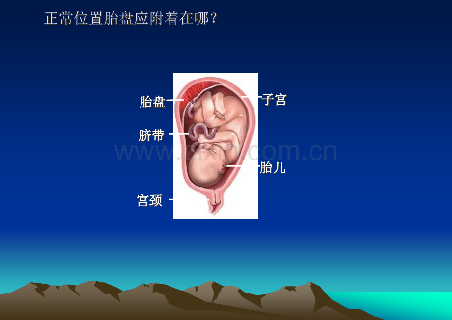 前置胎盘教学查房.ppt_第3页