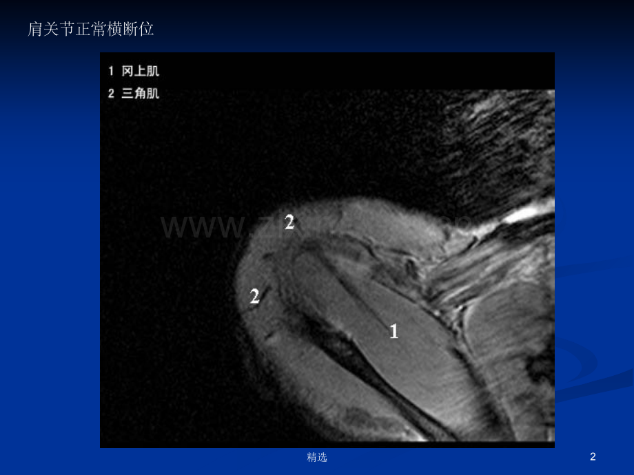 肩关节MR解剖.ppt_第2页