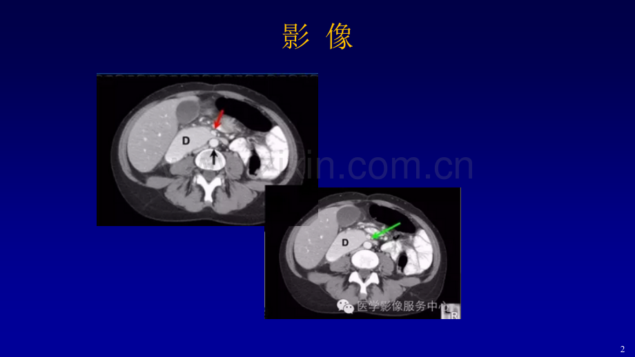 十二指肠淤滞症.pptx_第2页