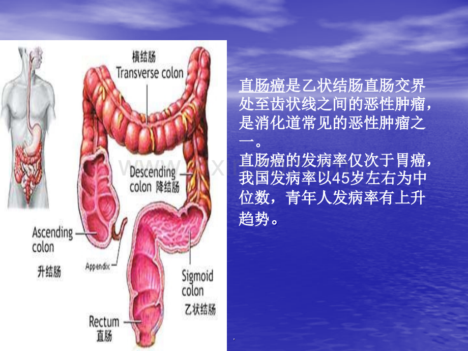 直肠癌的护理教学查房.ppt_第3页