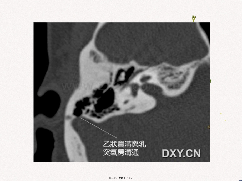 耳鸣与乙状窦憩室2.ppt_第3页