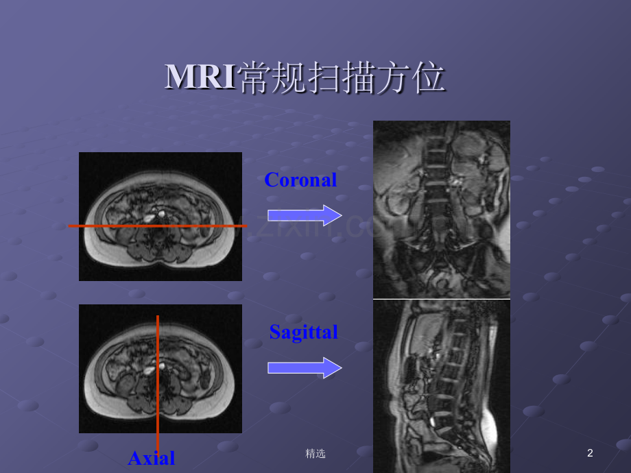 脊柱正常MRI表现及常见疾病.ppt_第2页