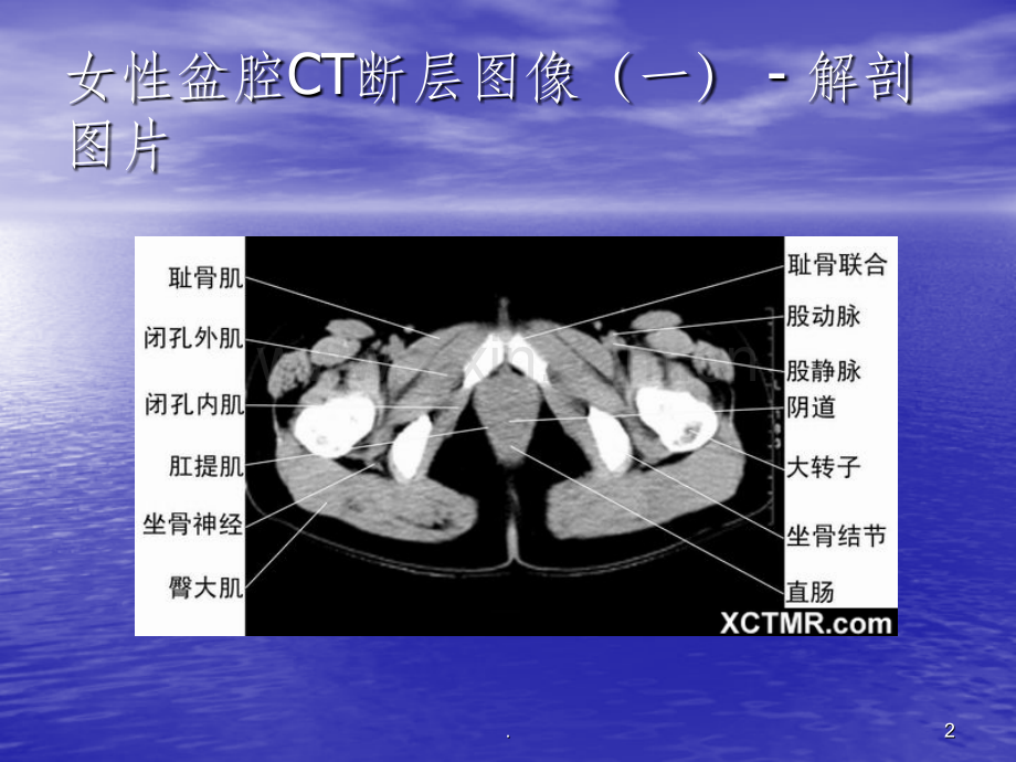 盆腔CT诊断01232.ppt_第2页