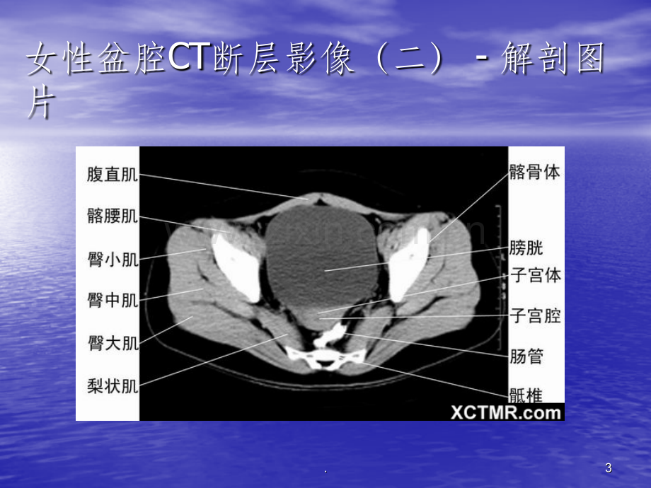 盆腔CT诊断01232.ppt_第3页