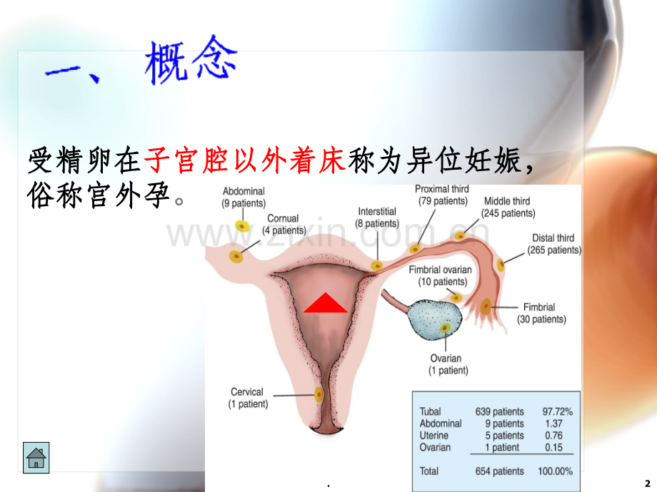 宫外孕(图文并茂).ppt_第2页