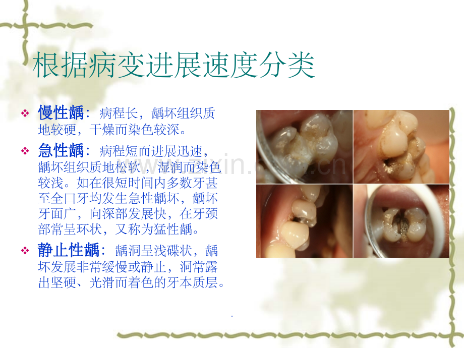 龋齿的分类.ppt_第3页