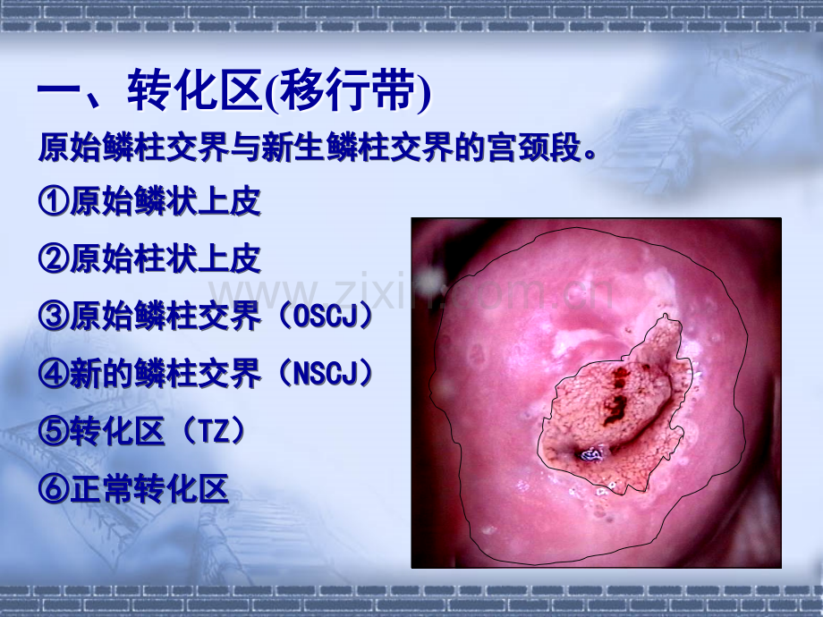 宫颈病变几个重要概念及问题.ppt_第3页