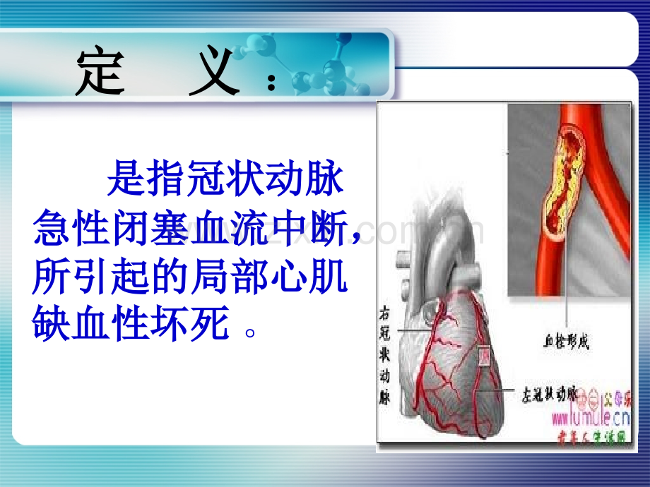 心肌梗死抢救护理医学课件演示稿.ppt_第3页