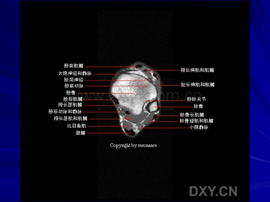 正常踝关节MR解剖.ppt_第3页