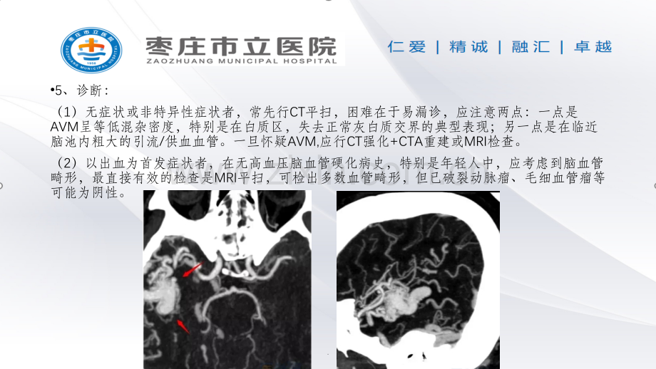 常见脑血管畸形的影像学表现.ppt_第3页