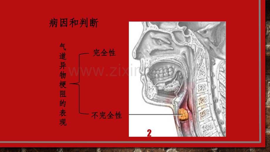 气道异物梗阻.ppt_第2页