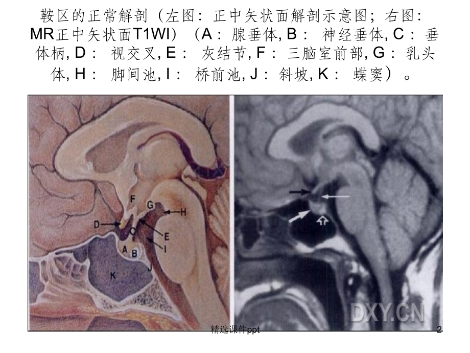 鞍区解剖及病变的MR改变.ppt_第2页