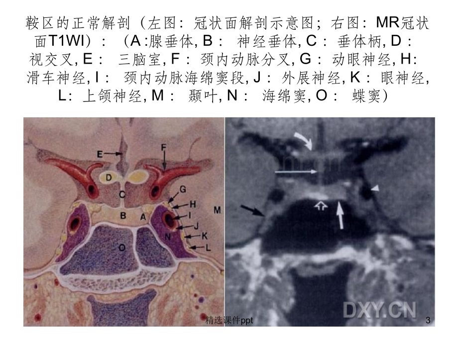 鞍区解剖及病变的MR改变.ppt_第3页