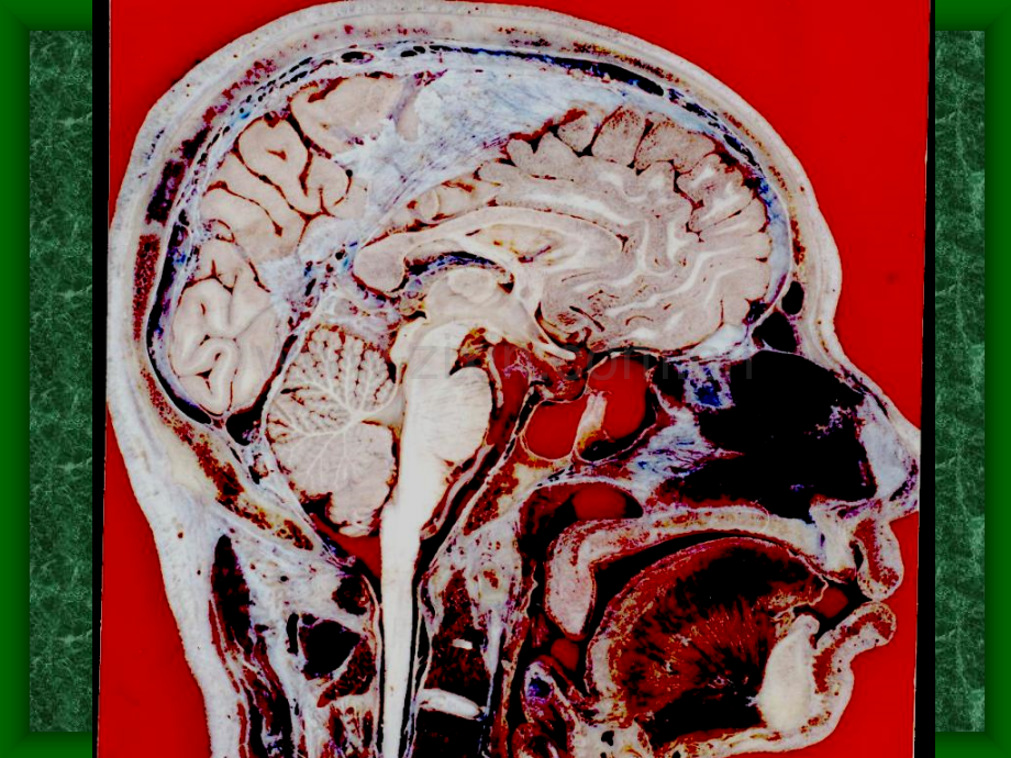 颅脑失状断层解剖.pptx_第2页