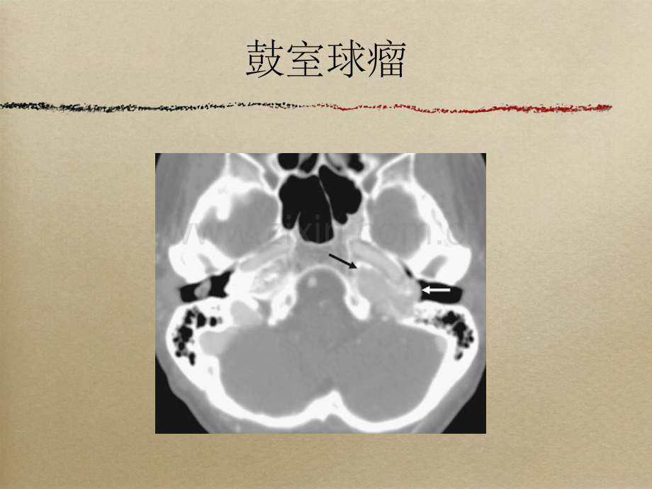 搏动性耳鸣的影像表现.pptx_第3页