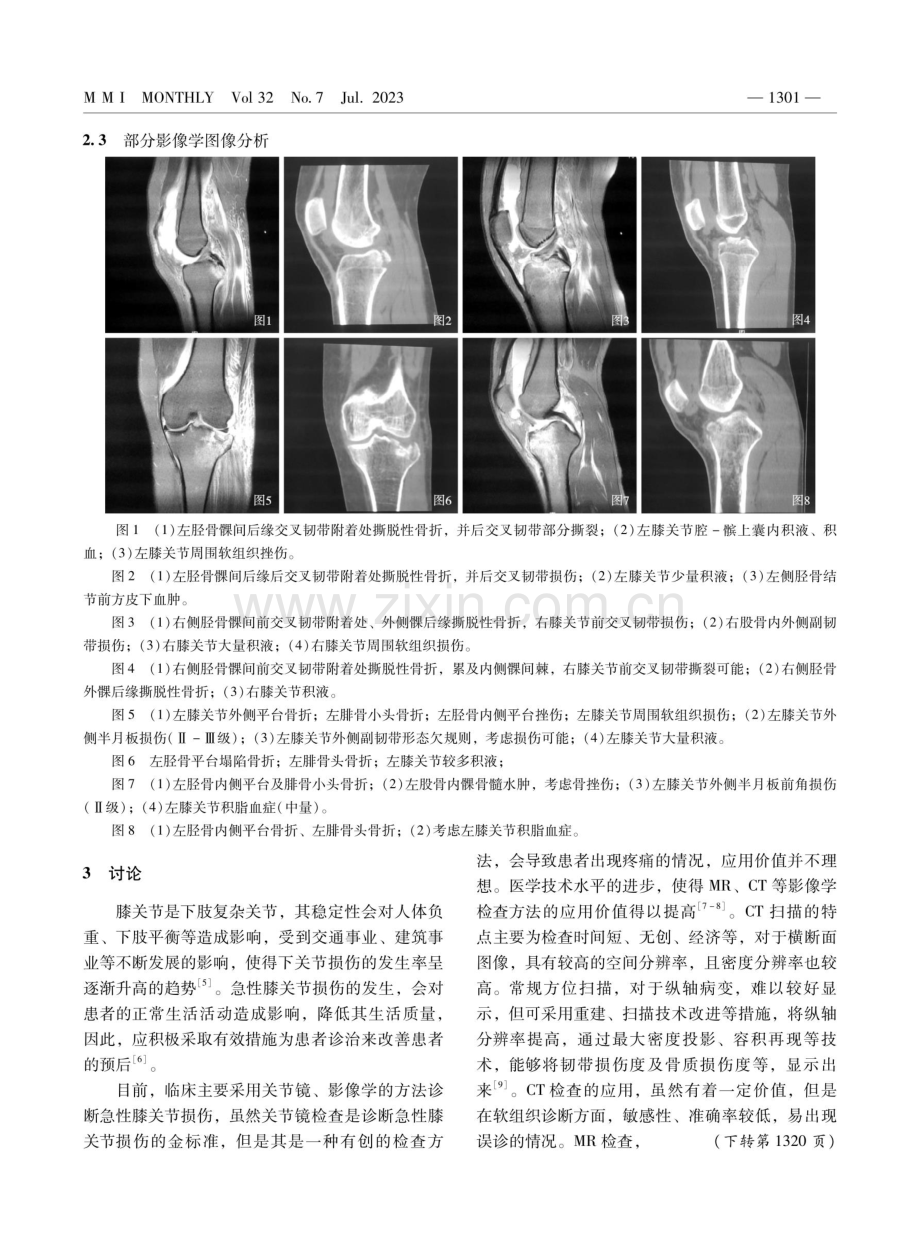 急性膝关节损伤应用CT与MR诊断的临床价值探讨.pdf_第3页