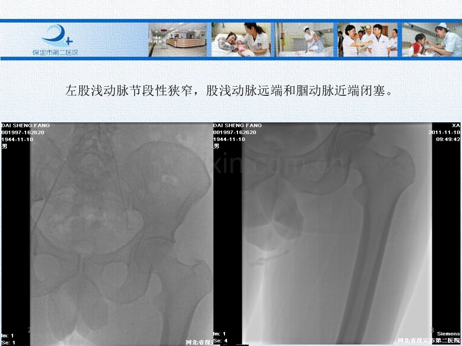 下肢动脉硬化闭塞症的腔内治疗.ppt_第3页