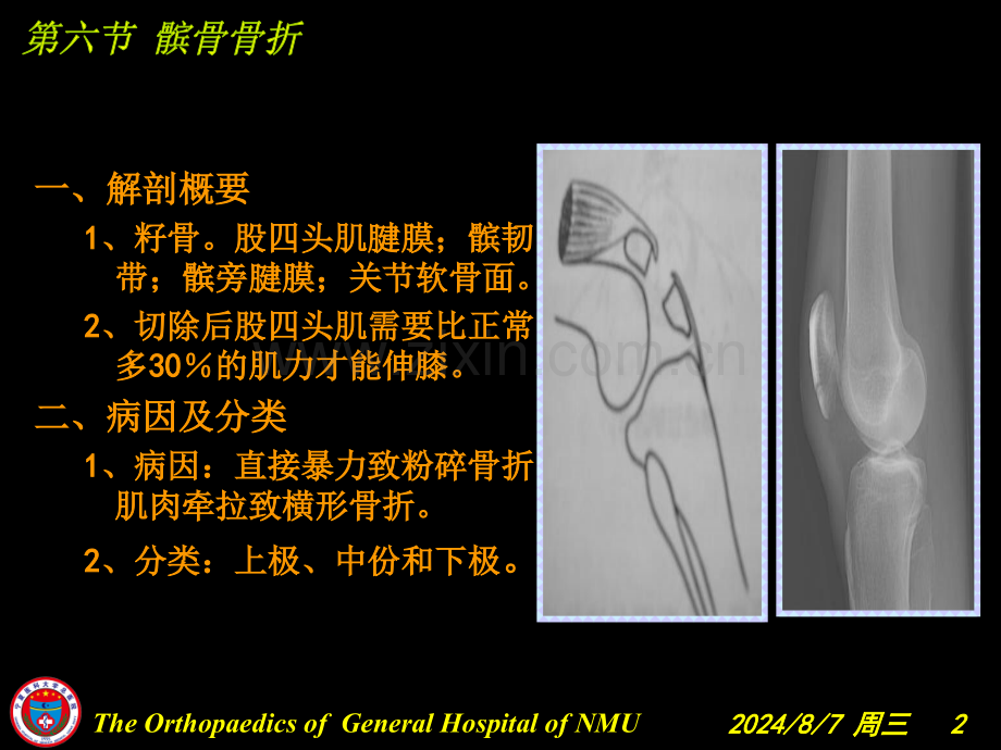 膝关节损伤韧带半月板骨.pptx_第2页