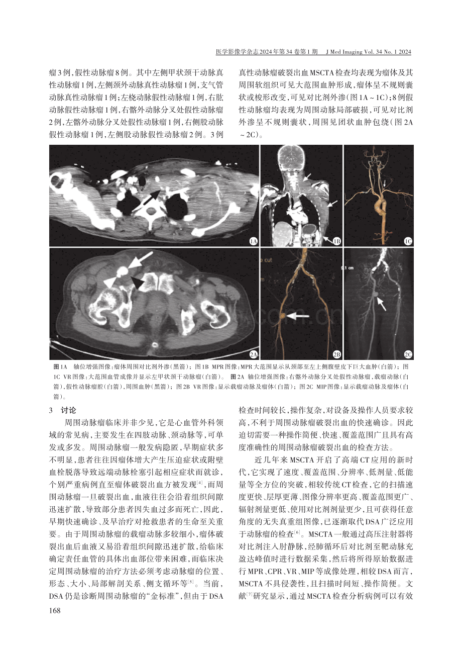 多层螺旋CT血管成像在周围动脉瘤破裂出血诊断中的临床应用.pdf_第2页