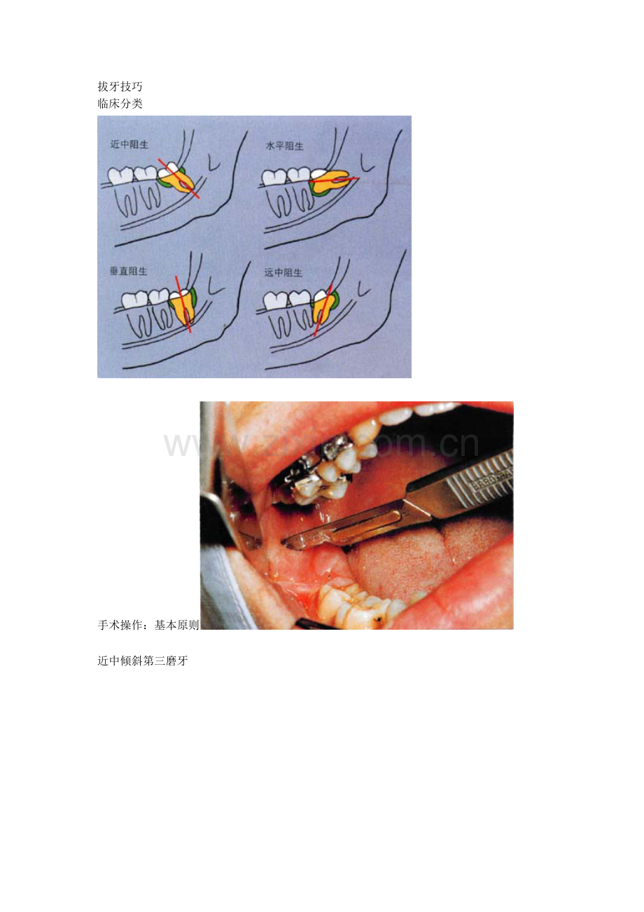 阻生牙拔出.doc_第1页