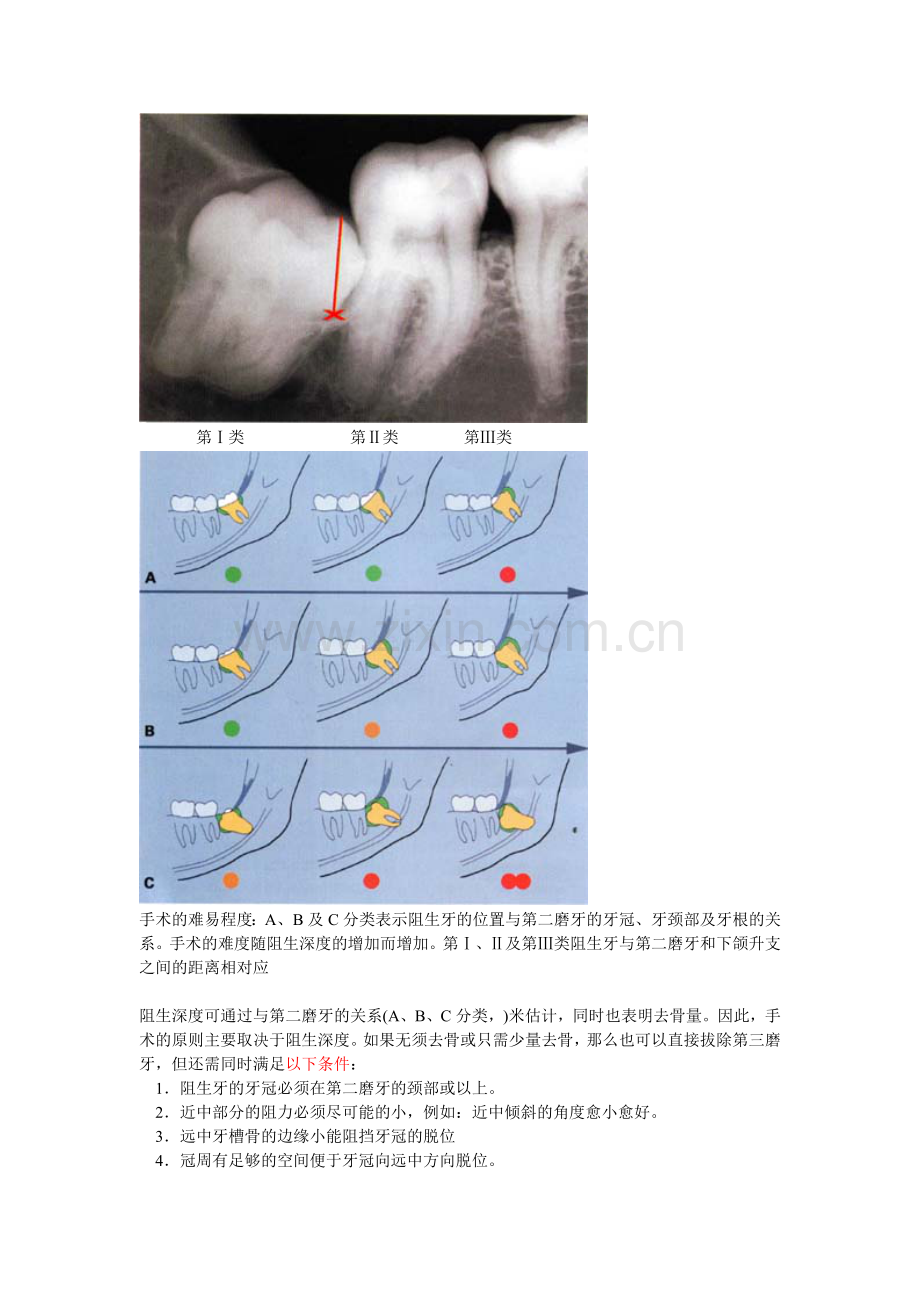 阻生牙拔出.doc_第2页